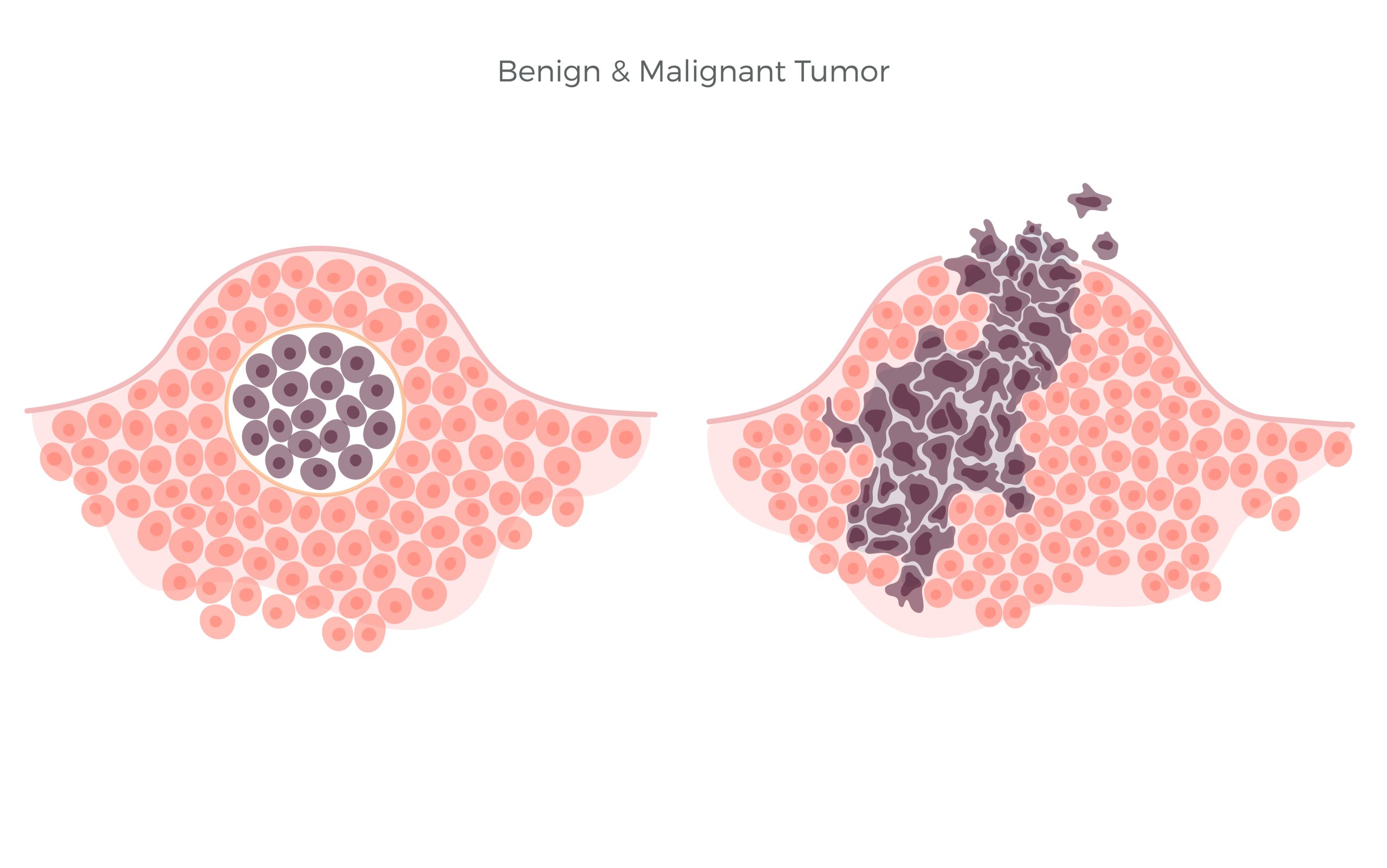 Mengenal Perbedaan Tumor Jinak dan Tumor Ganas